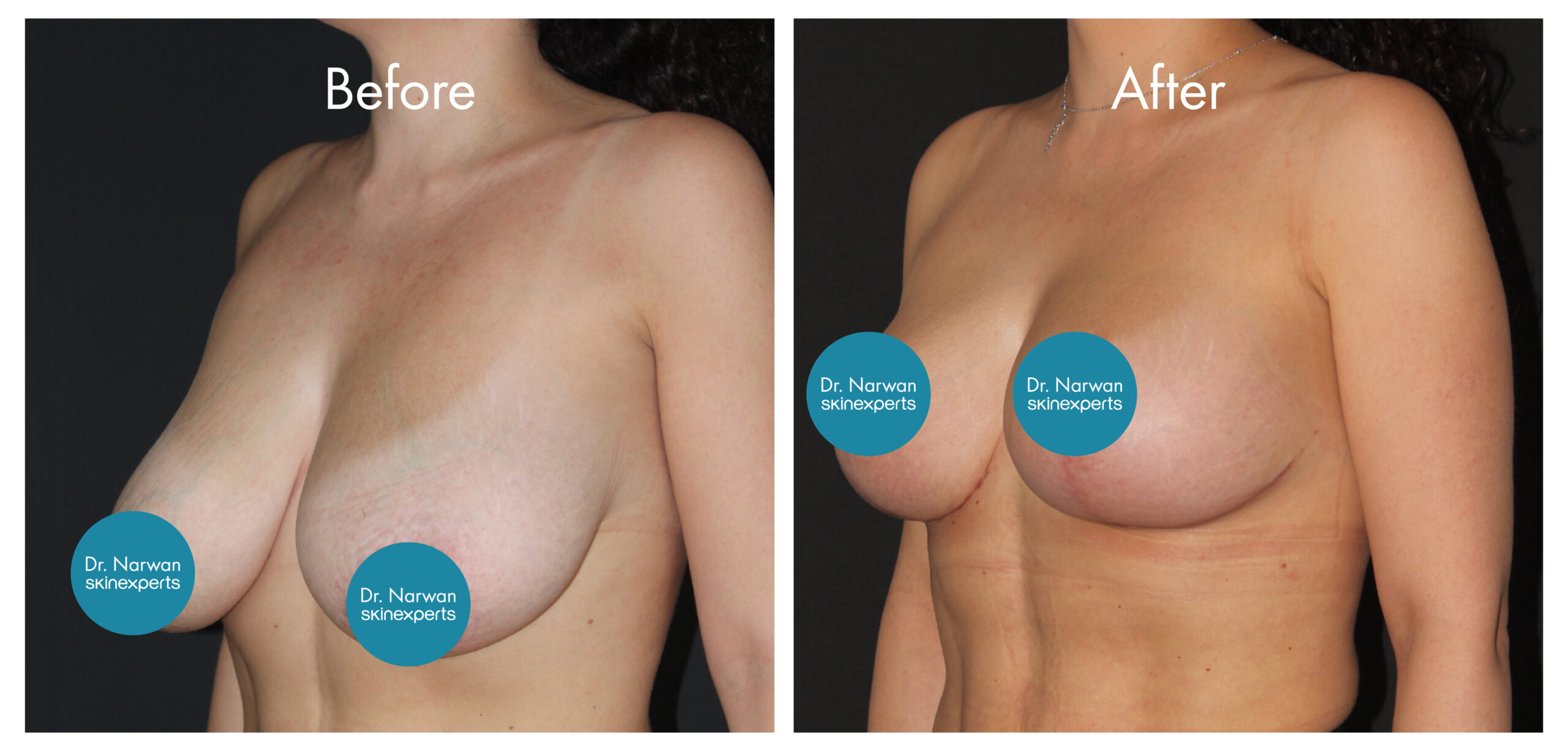 2411_SE_Breast-Lift_BA_1-scaled