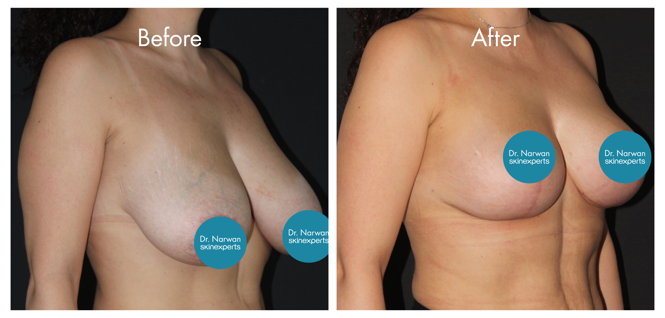 2411_SE_Breast-Lift_BA_2-scaled