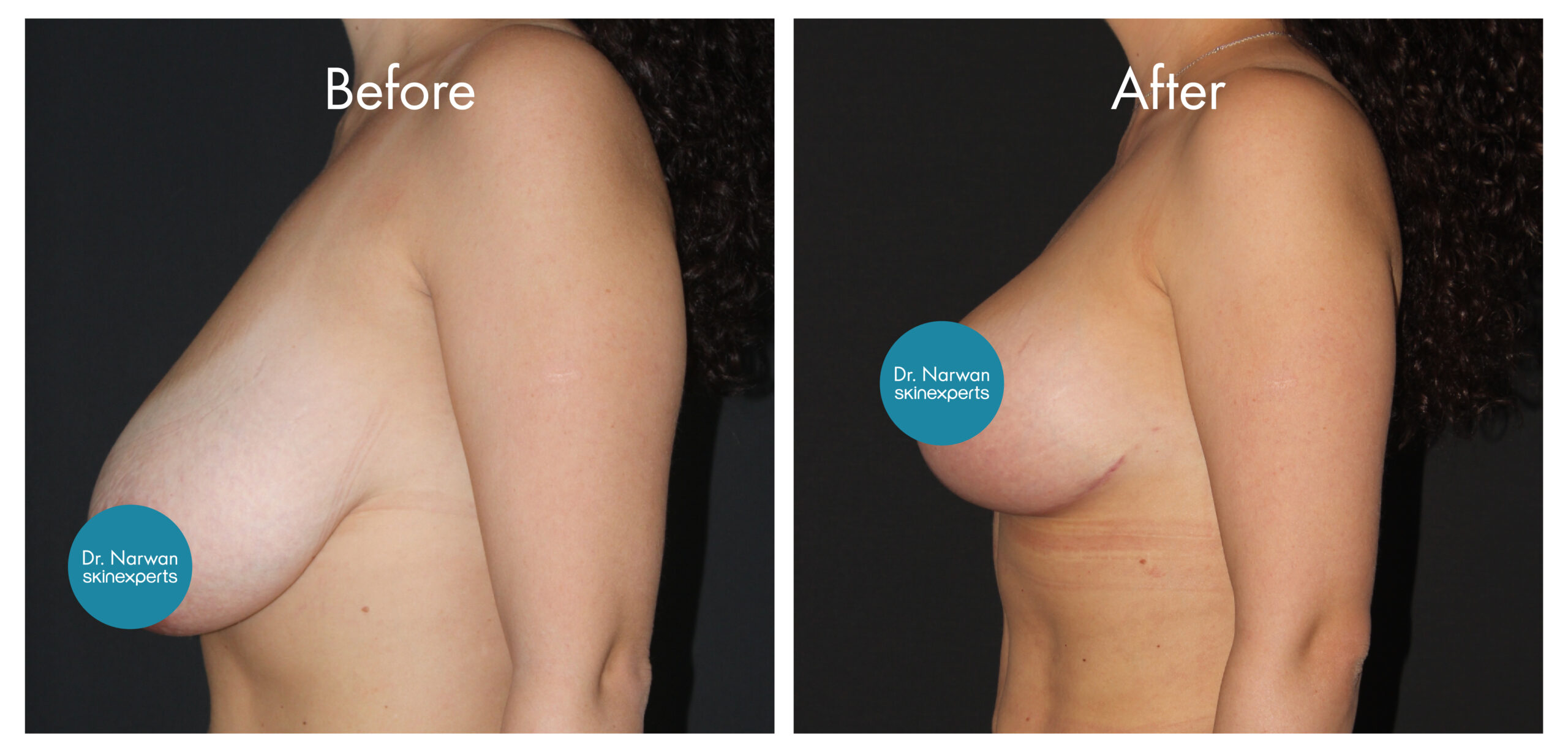 2411_SE_Breast-Lift_BA_4-scaled