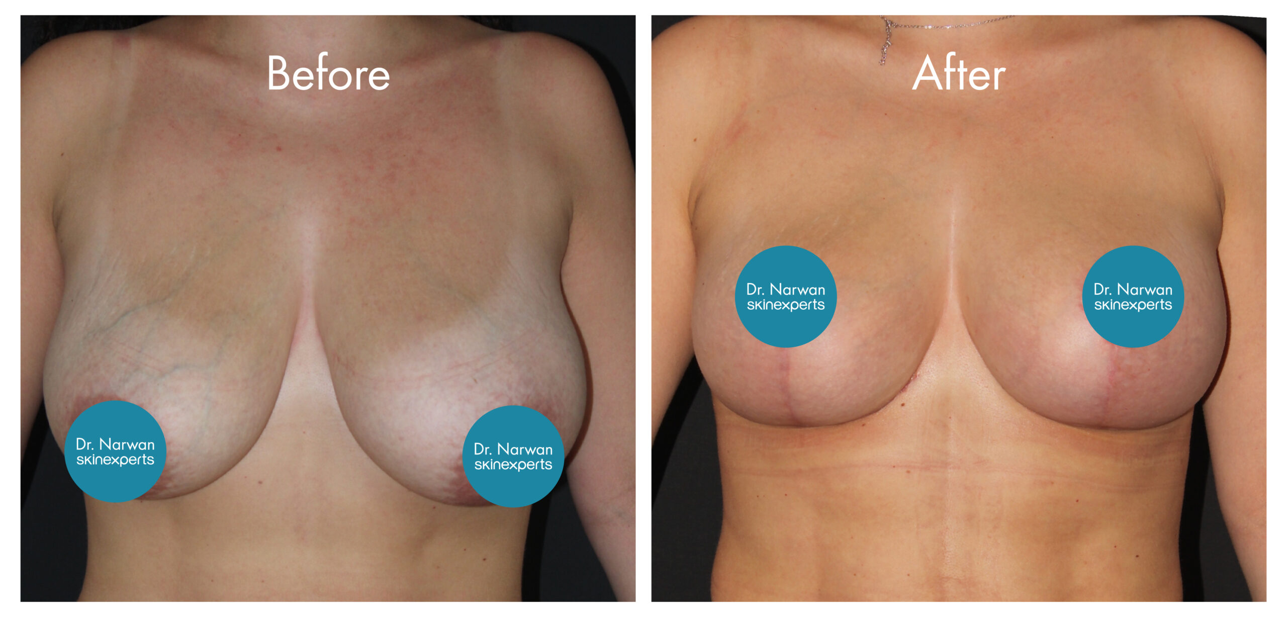 2411_SE_Breast-Lift_BA_5-scaled