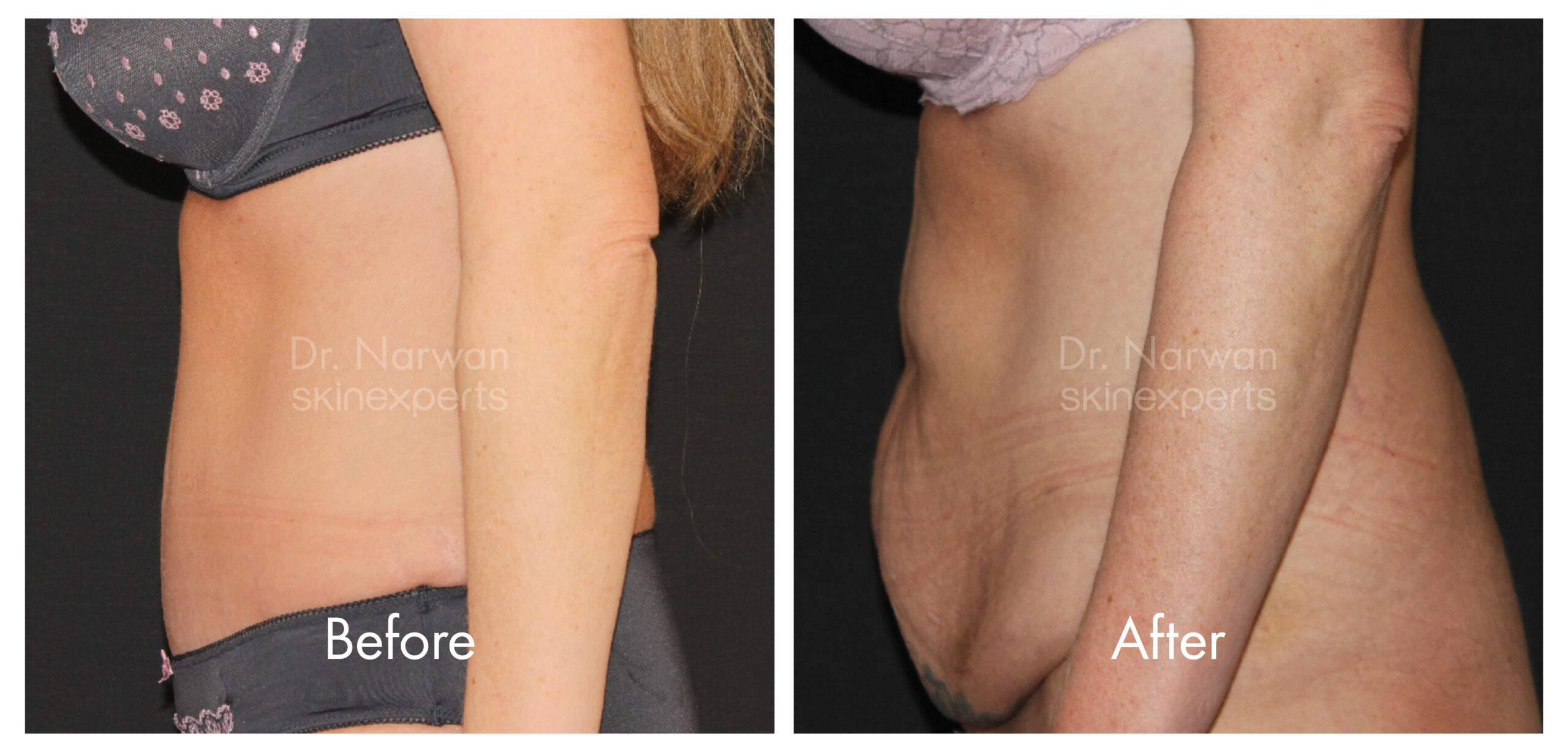 2411_SE_Tummy-Tuck_BA_1-scaled
