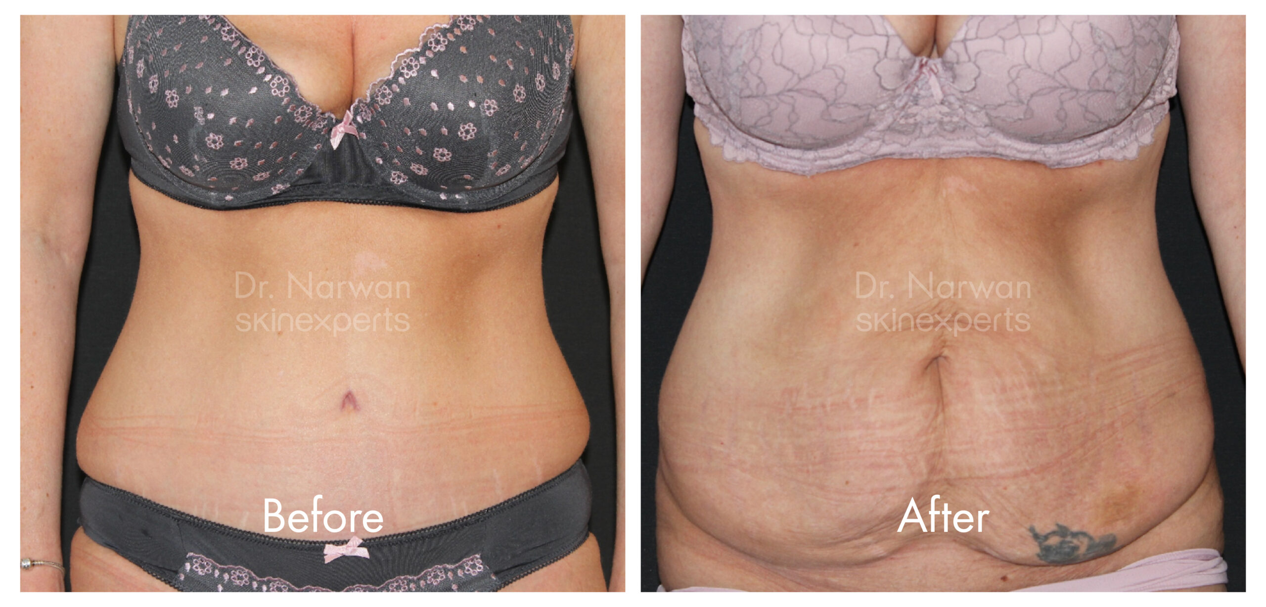 2411_SE_Tummy-Tuck_BA_2-scaled