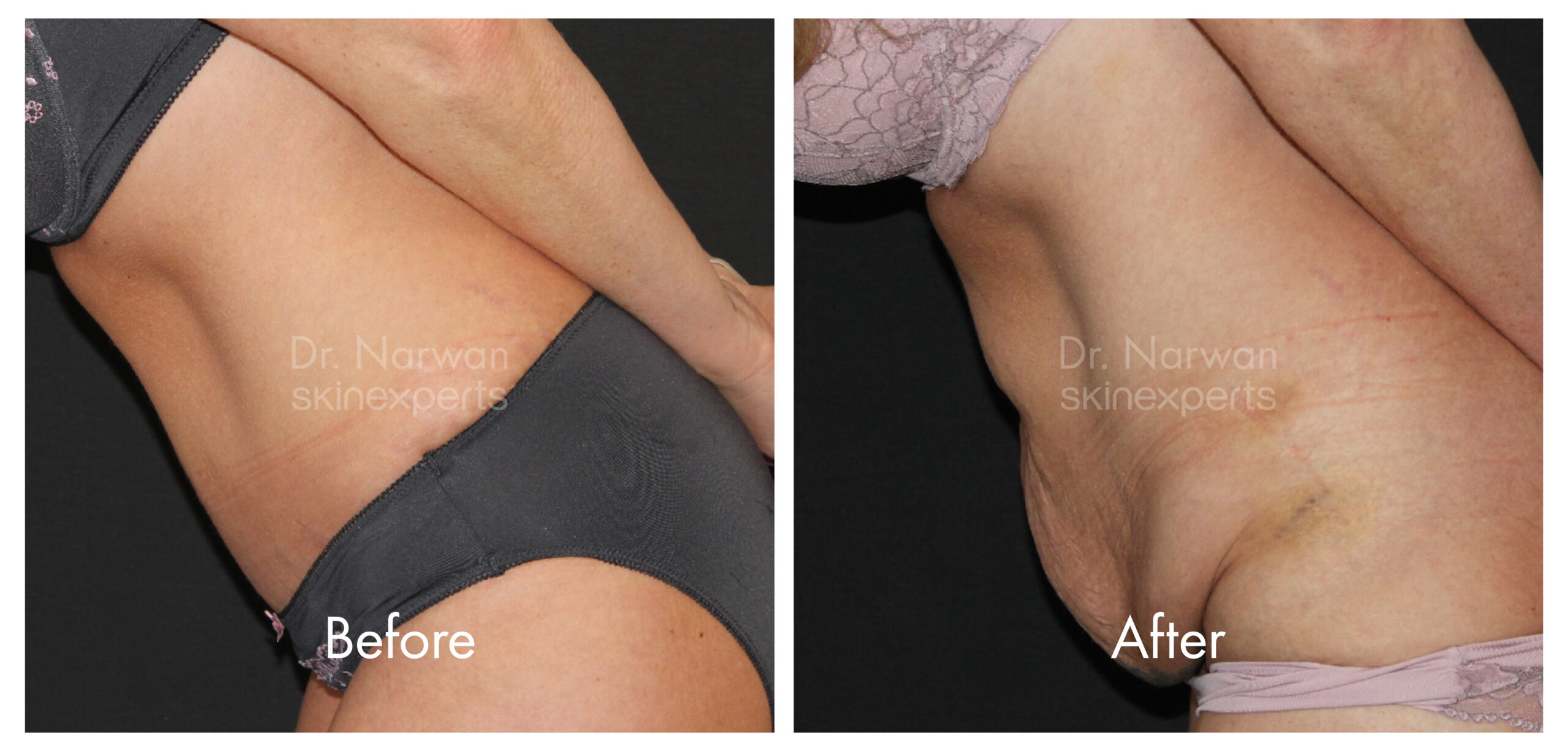 2411_SE_Tummy-Tuck_BA_3-scaled